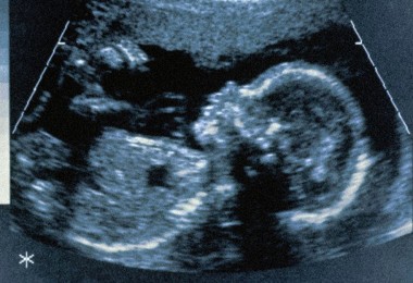 Imagine ultrasunet fetus in relatia cu paracetamol in sarcina