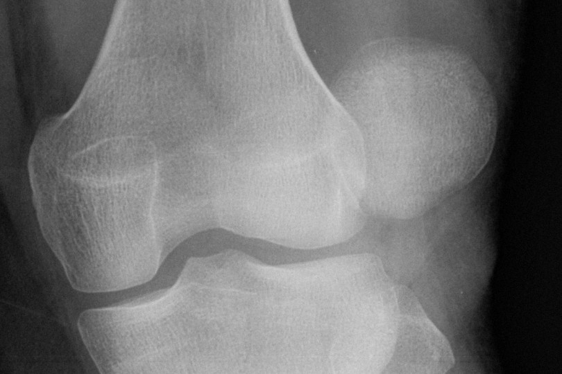 Radiografie la genunchi cu osteoartrita
